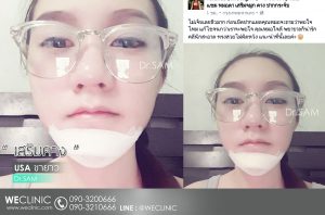 การดูแล หลัง ทำคาง