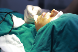 ซิลิโคนขายาว เสริมคางที่ไหนดี