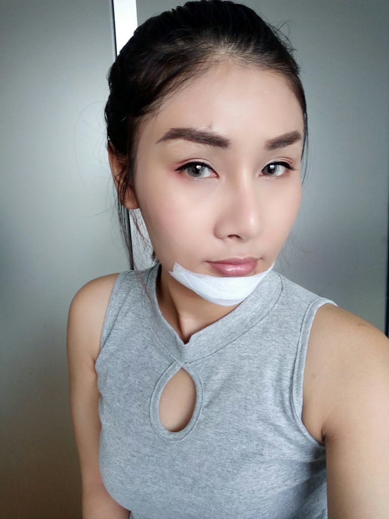 เสริมคาง