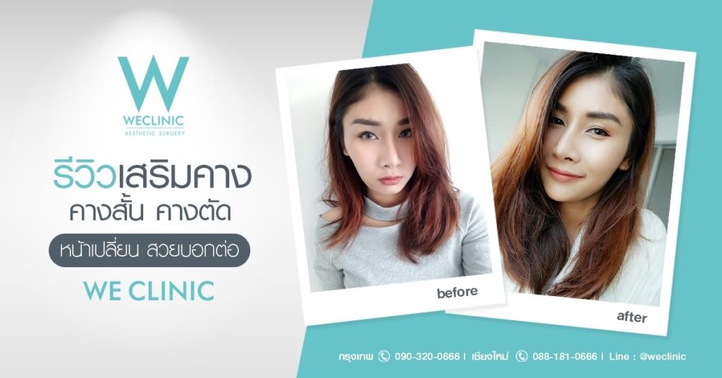 รีวิวเสริมคาง