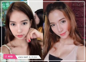 รีวิว เสริมคางที่ไหนดี