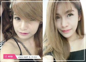 รีวิว เสริมคางที่ไหนดี