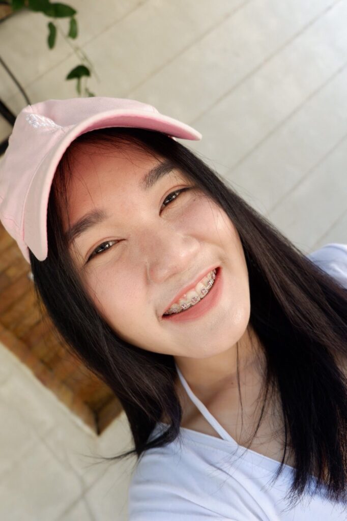 รีวิวก่อนเสริมจมูก