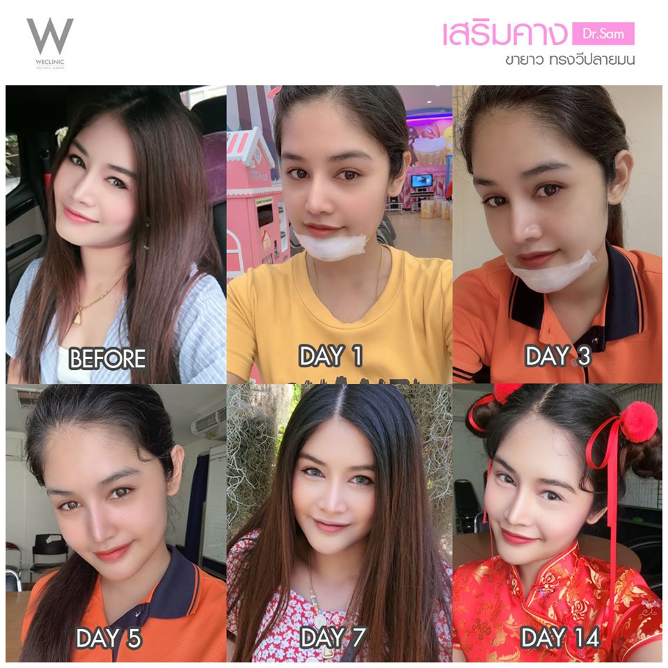 รีวิวหลังทำคางแผลนอก 14 วัน