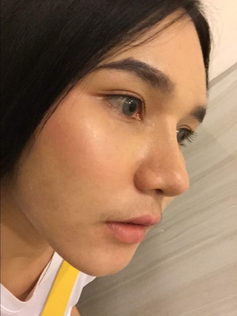 รีวิวหลังเสริมจมูก-น้องบิว-ด้านข้าง