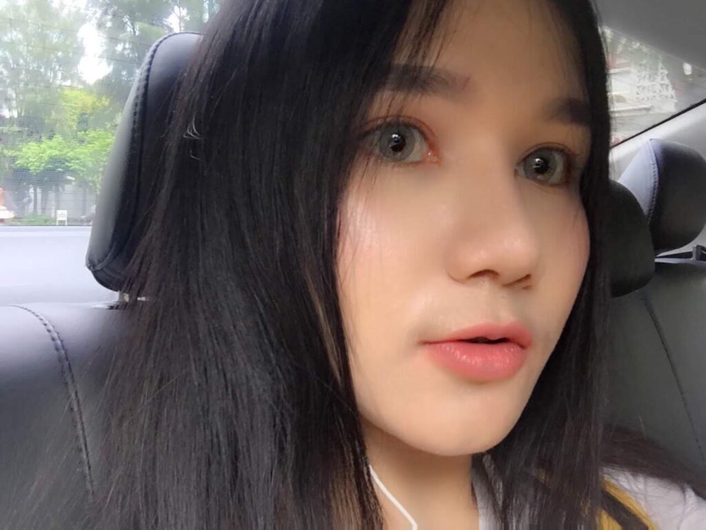 รีวิวหลังเสริมจมูก-น้องบิว