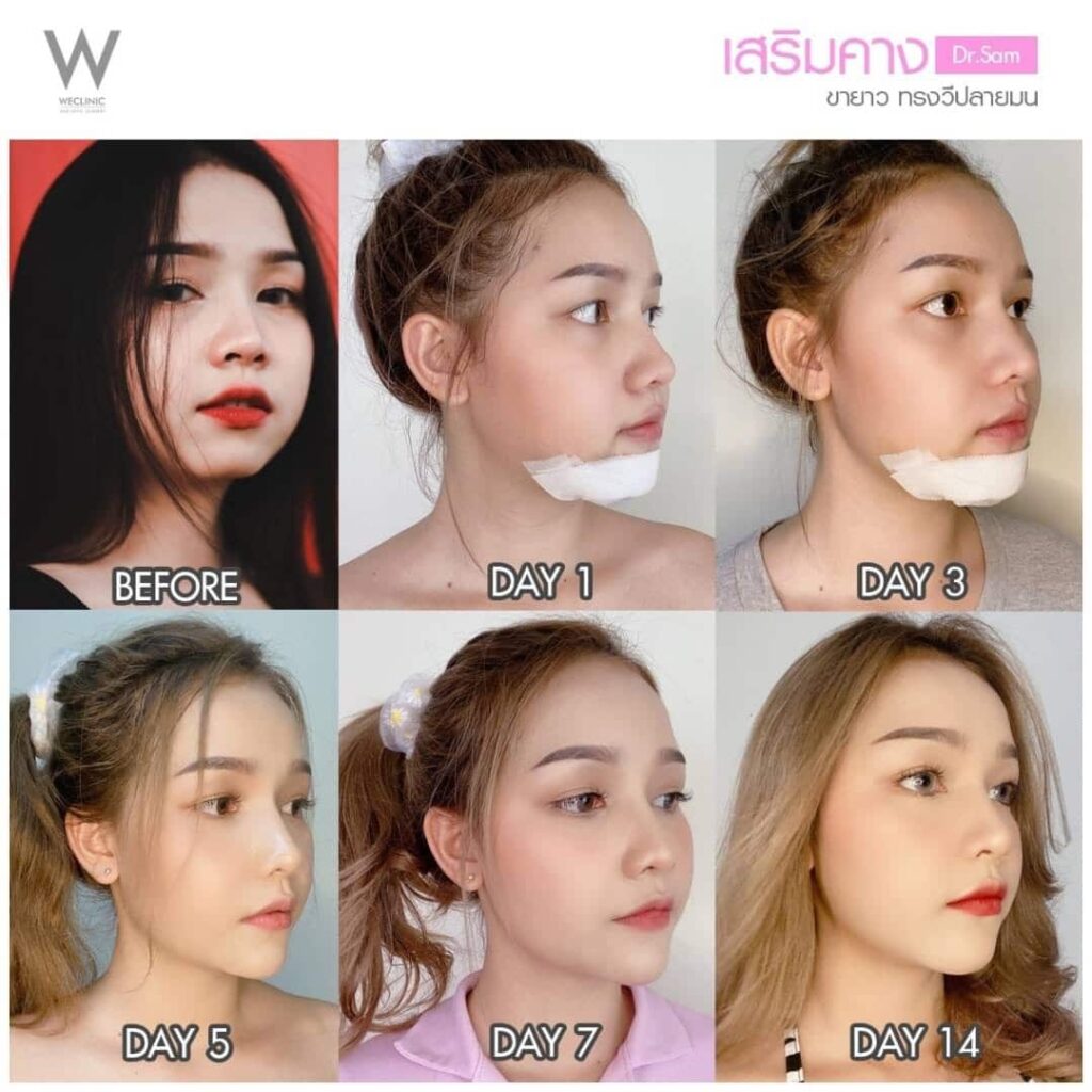 รีวิวเสริมคางแผลนอก ขายาว ทรงวีปลายมน สวยใน 14 วัน