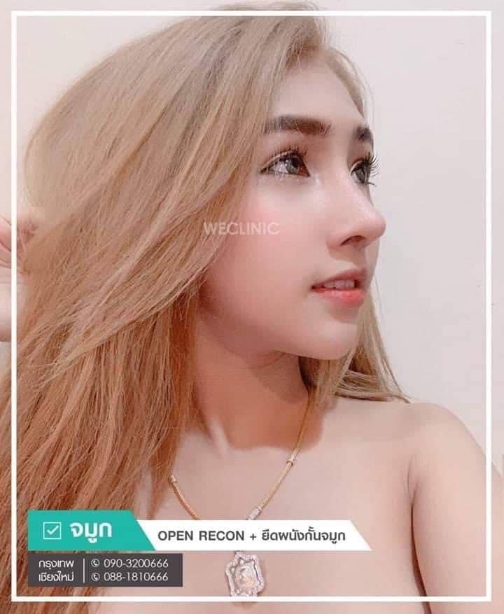 รีวิวเสริมจมูกแบบโอเพ่น
