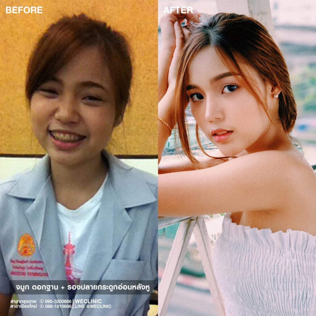 รีวิวเสริมจมูก-ก่อนทำ-หลังทำ