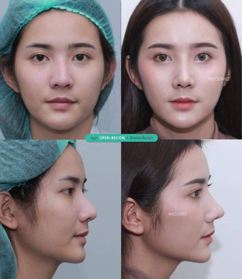 รีวิวเสริมจมูก-แก้ไขปัญหา-ปลายจมูกโต