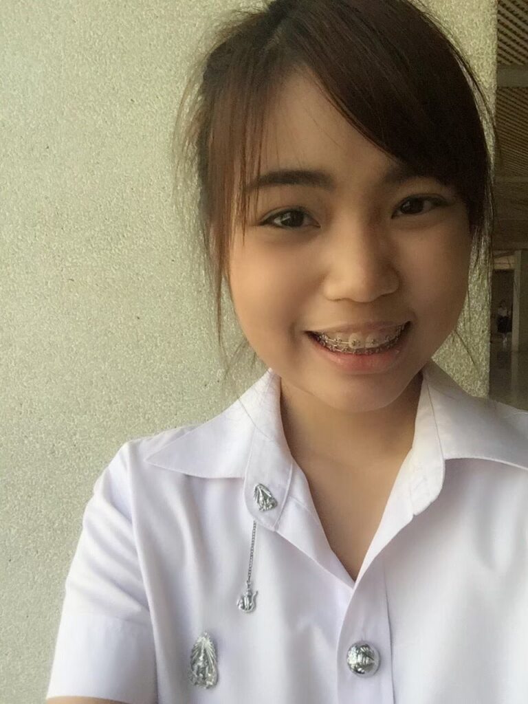 รีวิวเสริมจมูก-แก้ไข-ดั้งแหมบ-เนื้อจมูกน้อย-ผิวบาง