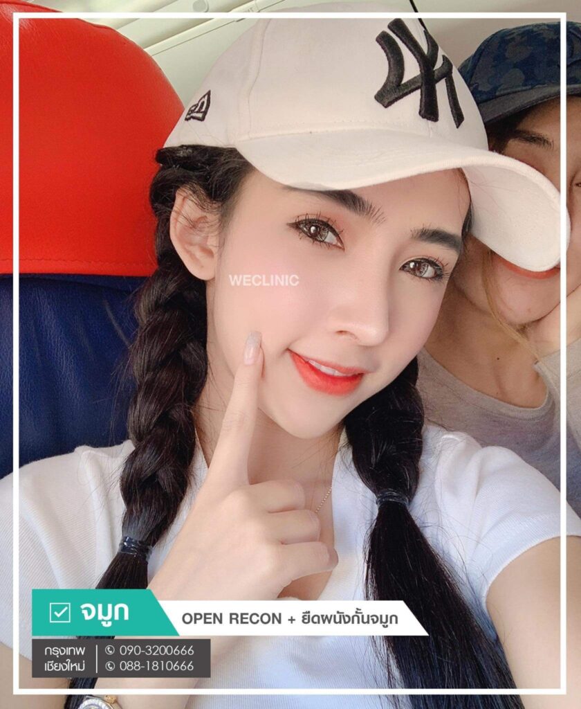 รีวิวเสริมจมูก-Open-ปรับโครงสร้าง-ยืดผนังกั้นจมูก