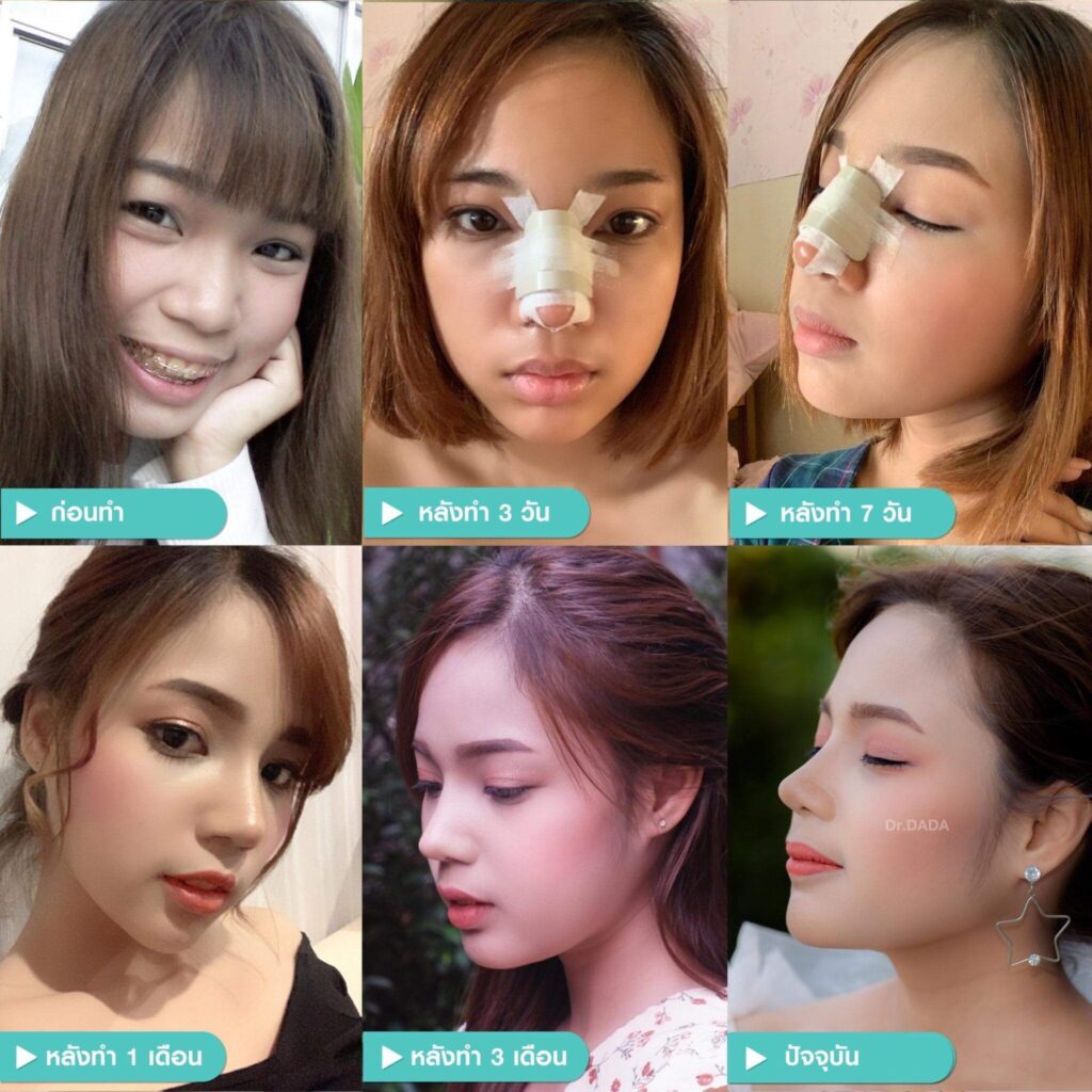 รีวิวเสริมจมูก-timeline-ตั้งแต่ต้นจนจบ