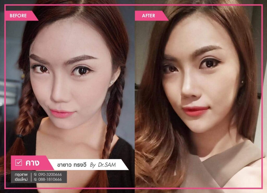 รีวิว เสริมคางแผลนอก ขายาว ทรงวี หมอแซม