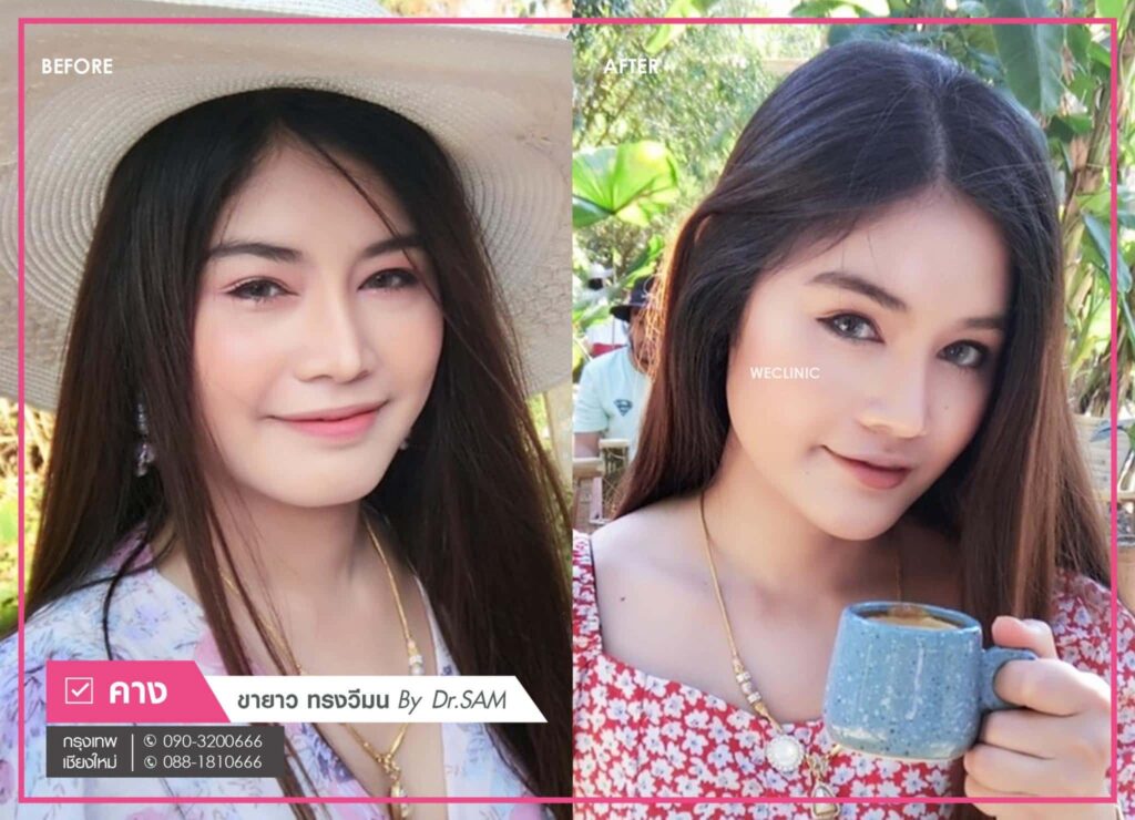 หลังเสริมคางแผลนอก ขายาว ทรงวีมน หมอแซม