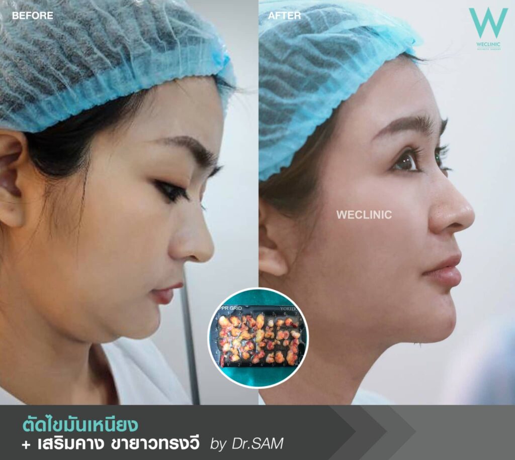 เสริมคางแผลนอก ตัดไขมันเหนียง