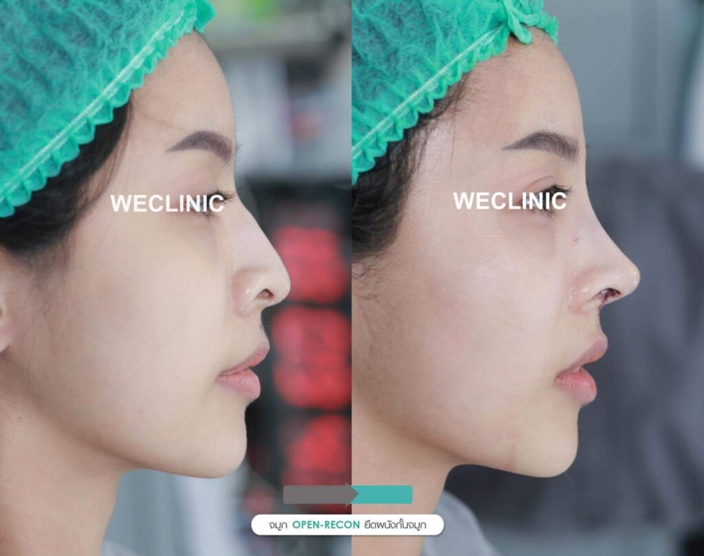 จมูกงุ้ม-แก้ไข-ด้วยการเสริมจมูกแบบโอเพ่น
