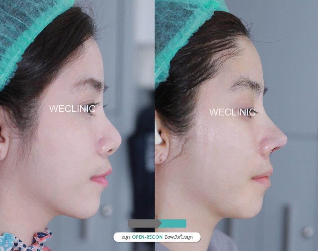 จมูกสั้น-จมูกแหงน-แก้ด้วยการเสริมจมูกแบบโอเพ่น