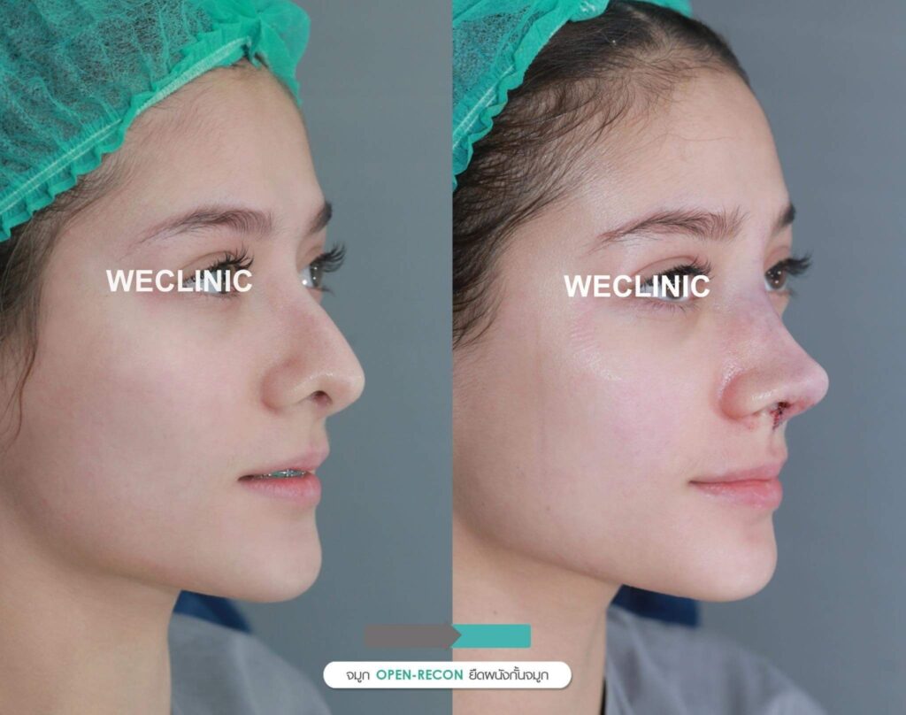 จมูกฮัมพ์สูง-ทำจมูกแบบโอเพ่น