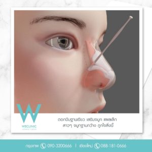 ตอกฐานจมูก