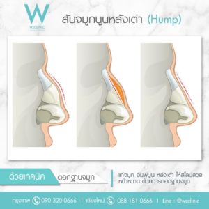 ตอกฐานจมูก