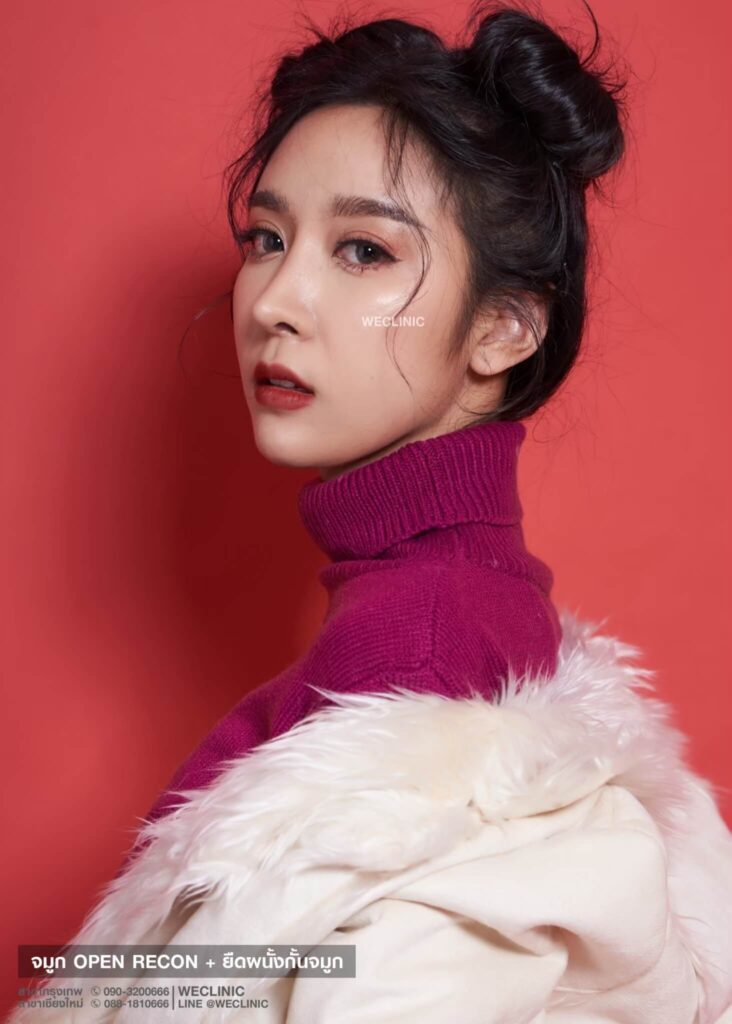 หลังเสริมจมูก-เทคนิค-open