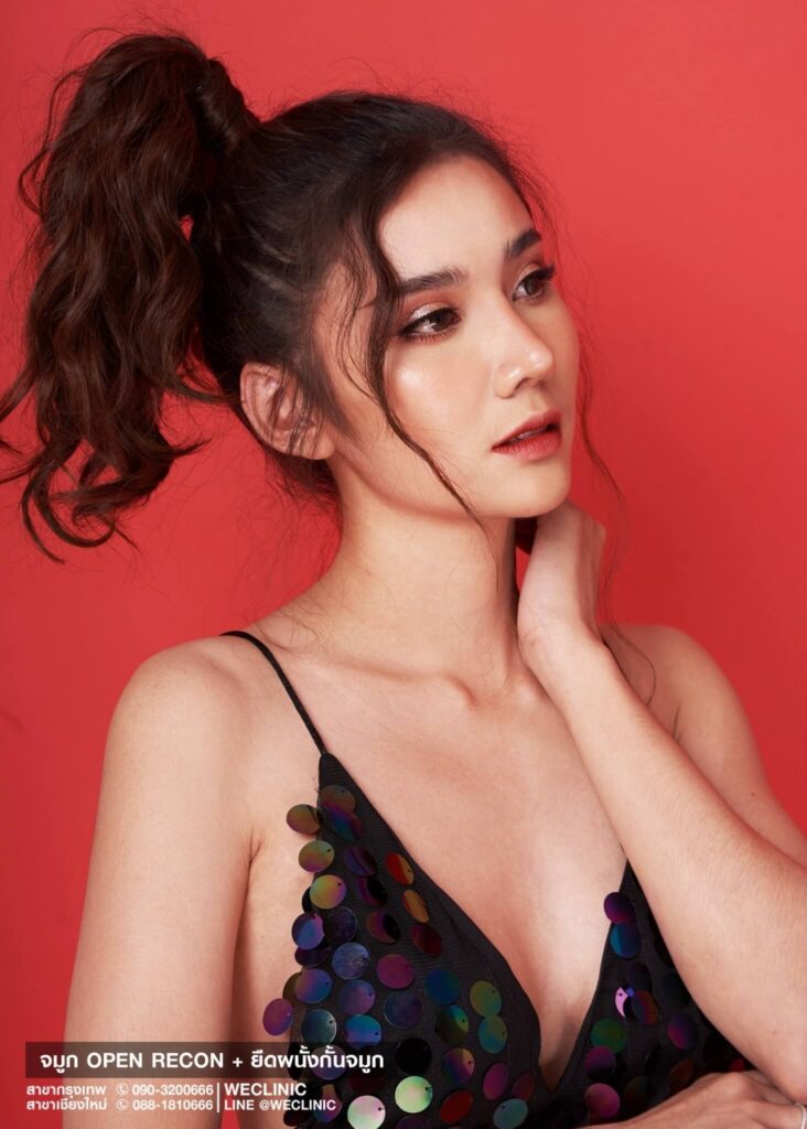 หลังแก้จมูก-เทคนิค-โอเพ่น-we-clinic