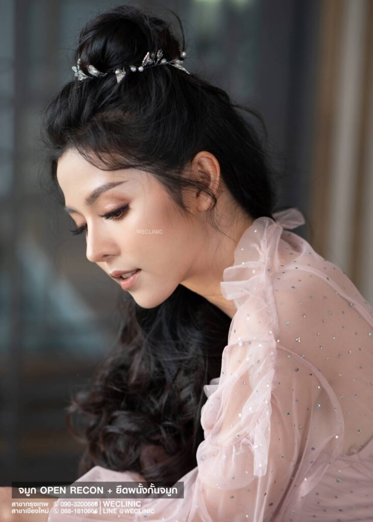 เสริมจมูกแบบโอเพ่น-recon-ยืดผนังกั้นจมูก