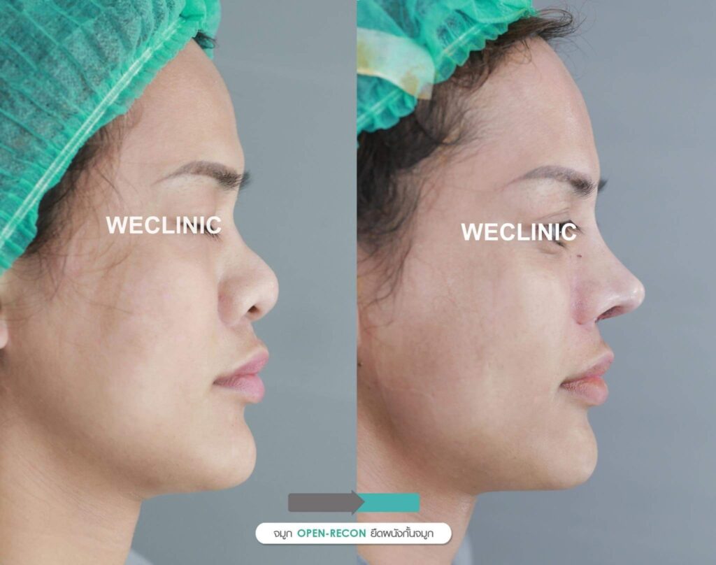 เสริมจมูกโอเพ่น-เคส-จมูกโต-เนื้อเยอะ