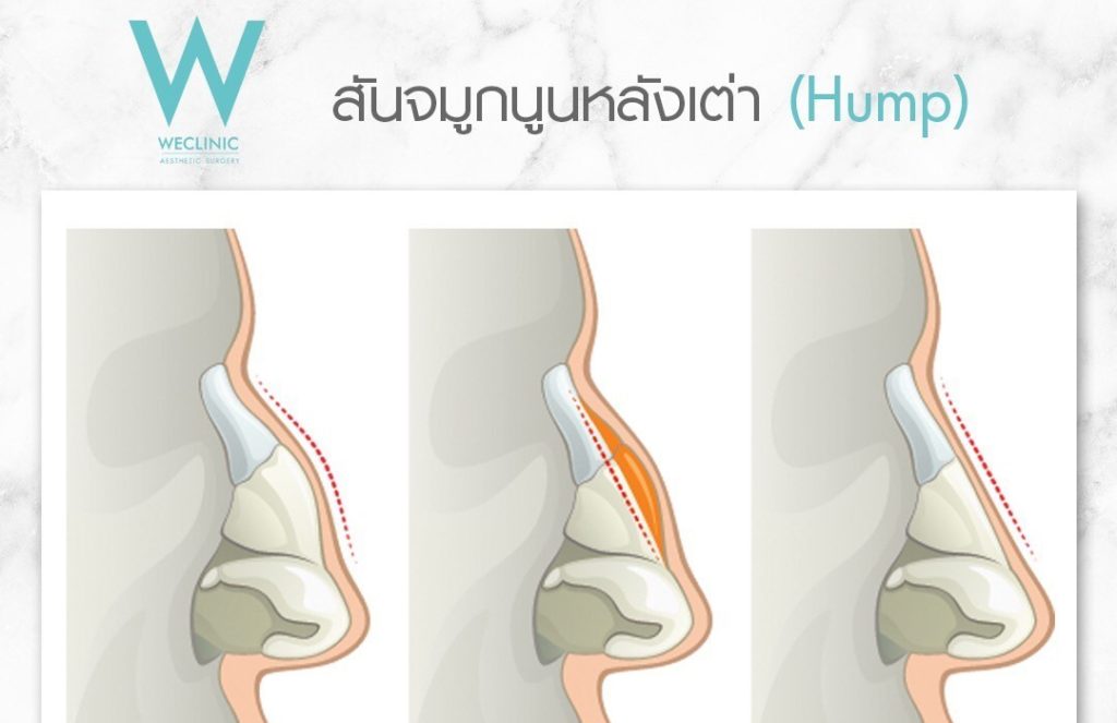 ตอกฐานจมูก