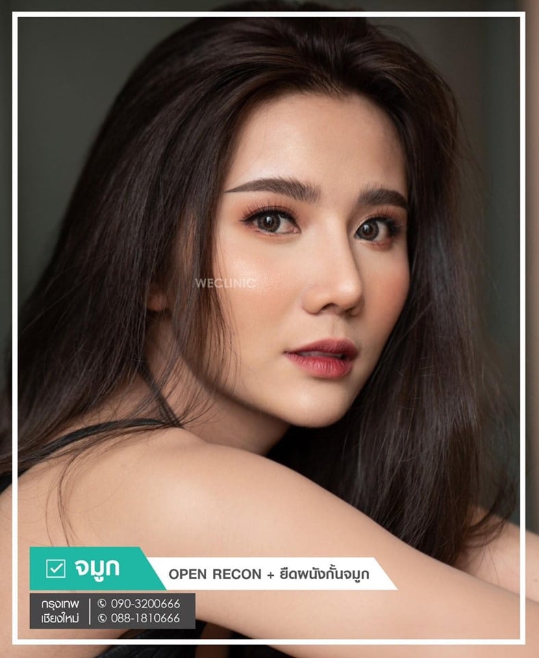 รีวิวทำจมูก-ดั้งโด่ง-เข้ารูป-เทคนิค-open