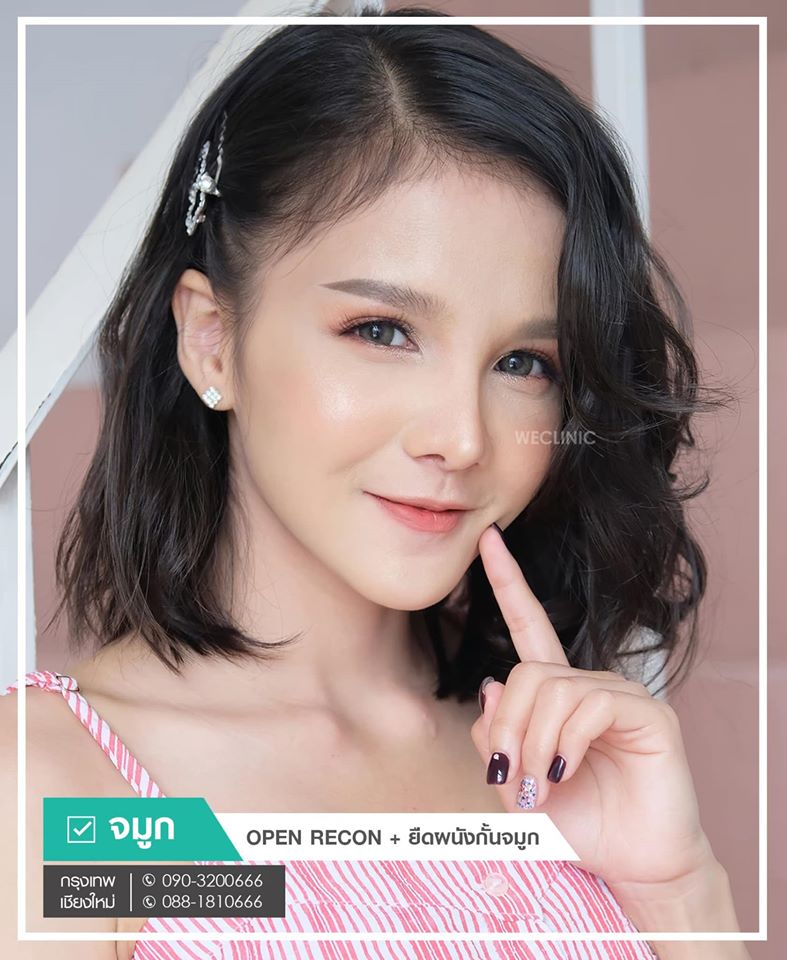 รีวิวเสริมจมูก-ยืดผนังกั้นจมูก-เทคนิค-open