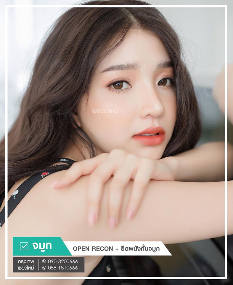 รีวิวเสริมจมูก-สวยธรรมชาติ-แบบ-open-we-clinic