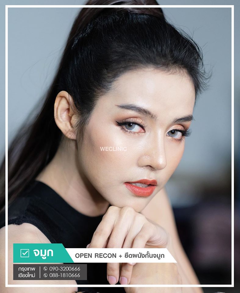 เสริมจมูกแบบโอเพ่น-ทรงสโลป-สวยเป็นธรรมชาติ