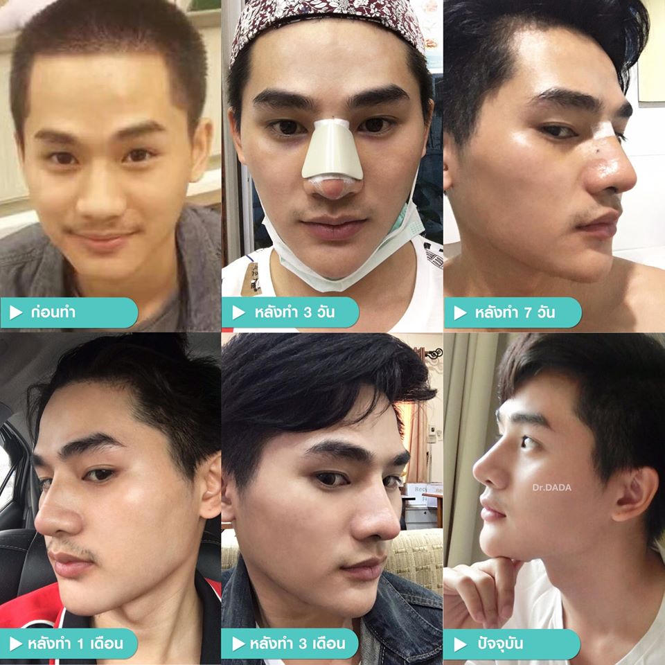 เสริมจมูกผู้ชาย-รีวิวจมูกผู้ชาย-ระยะเวลาพักฟื้น-หลังทำจมูกผู้ชาย-weclinic