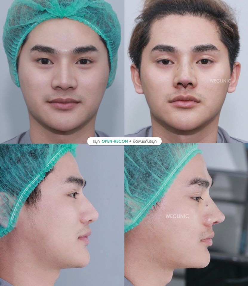 เสริมจมูกผู้ชาย-รีวิวจมูกผู้ชาย-หลังเสริมจมูกผู้ชาย-weclinic