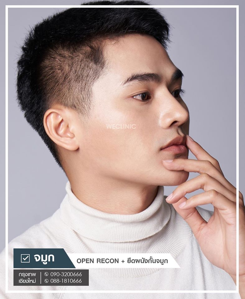 เสริมจมูกผู้ชาย-หลังทำจมูกผู้ชาย-รีวิวหลังทำ-เสริมดั้ง-ปัจจุบัน-weclinic