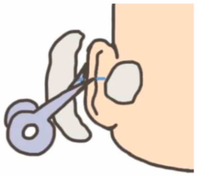 วิธีถอดผ้าก็อช ขั้นตอนที่ 3