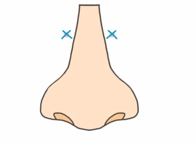 แผลตอกฐานจมูก