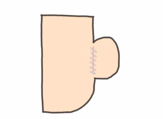 แผลบริเวณหลังหู