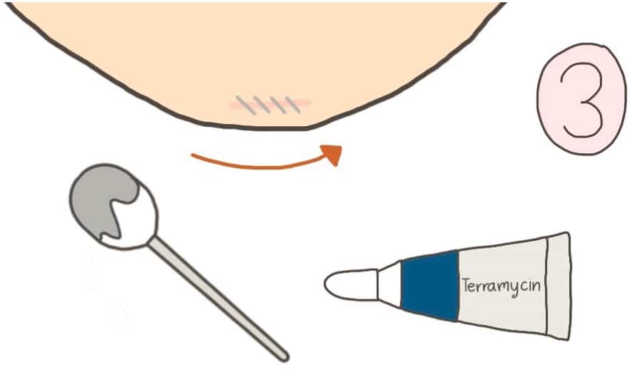 การทำความสะอาดแผลคางหลังทำคาง-ขั้นตอนที่-4