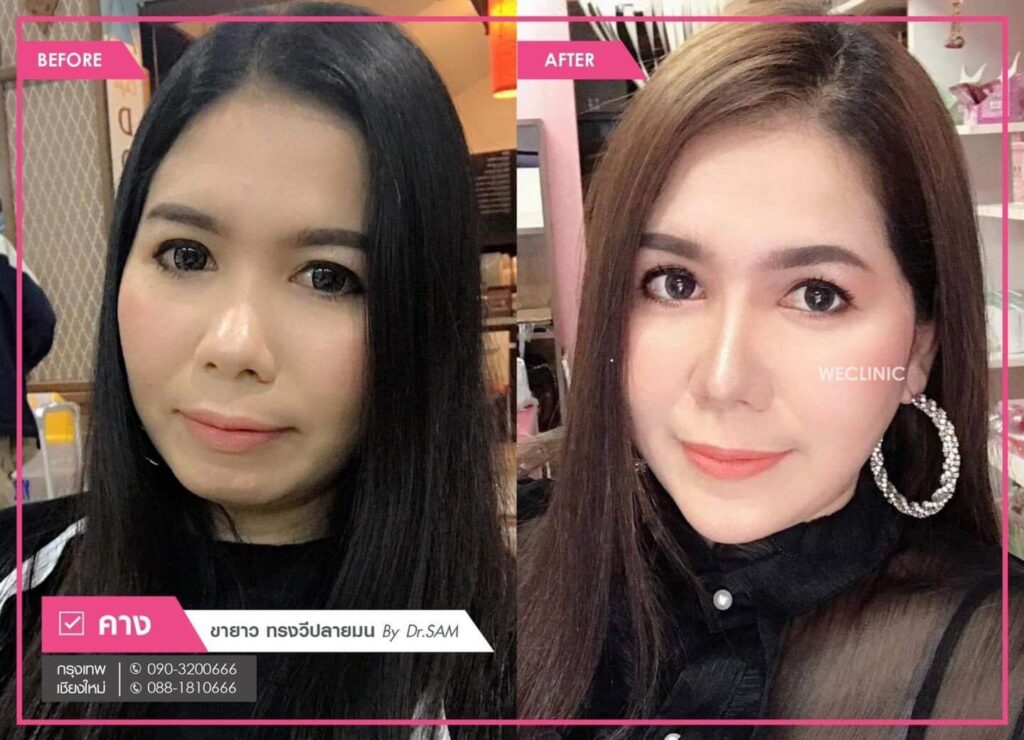 ทำคางแผลนอก-ขายาว-ทรงวี-ปลายมน