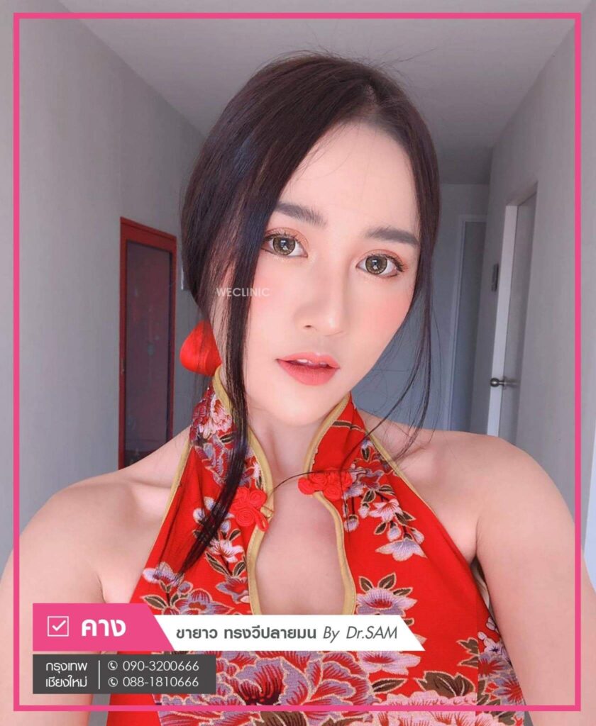 ทำคางแผลนอก-ทรงวี-ปลายมน