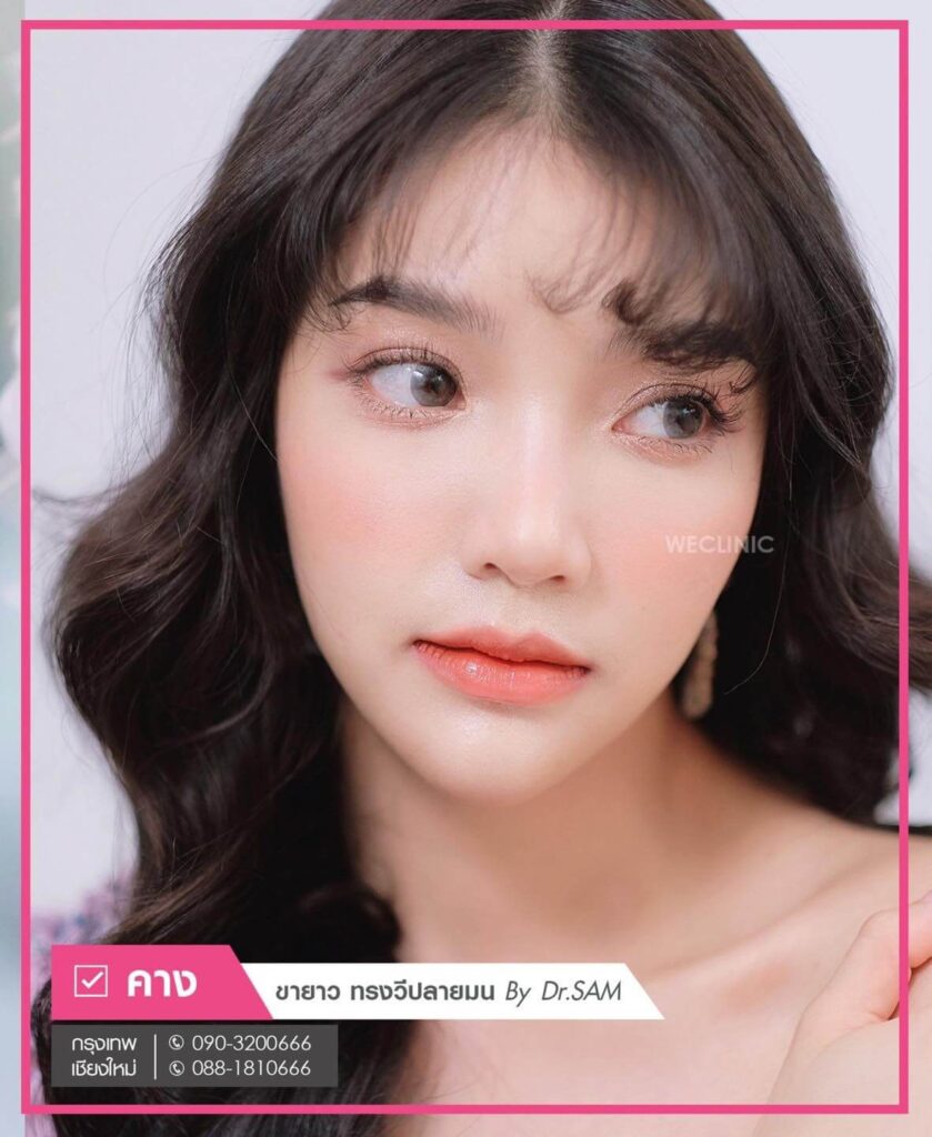 เสริมคางแผลนอก-ซิลิโคนขายาว-ทรงวีปลายมน