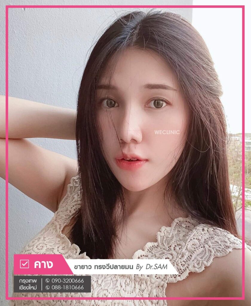 เสริมคางแผลนอก-ทรงขายาว-ทรงวีปลายมน