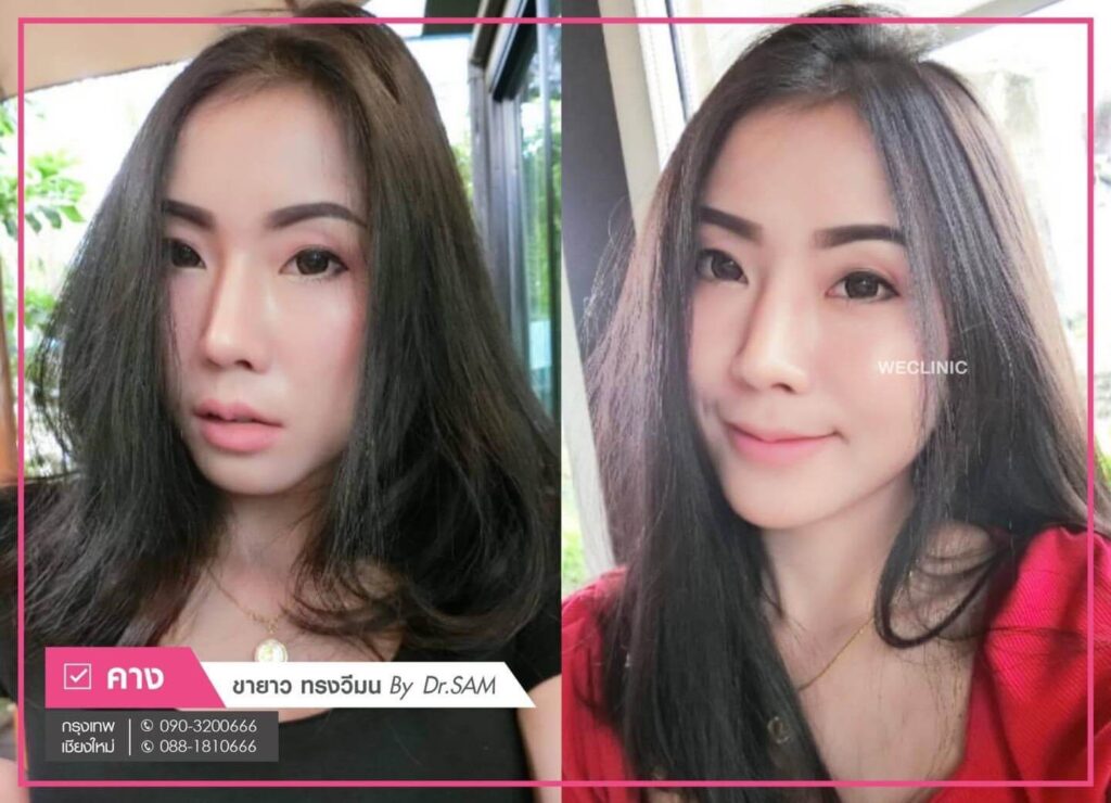 เสริมคางแผลนอก-We-clinic-ดียังไง