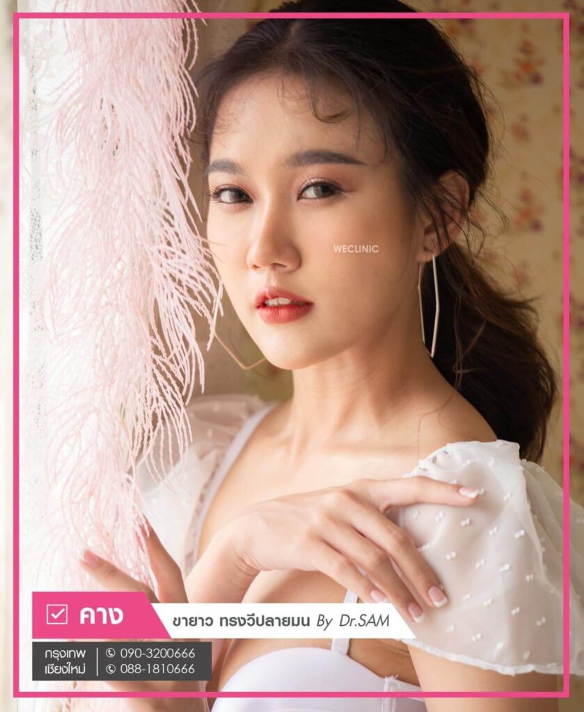 เสริมคาง-เทคนิค-แผลนอก