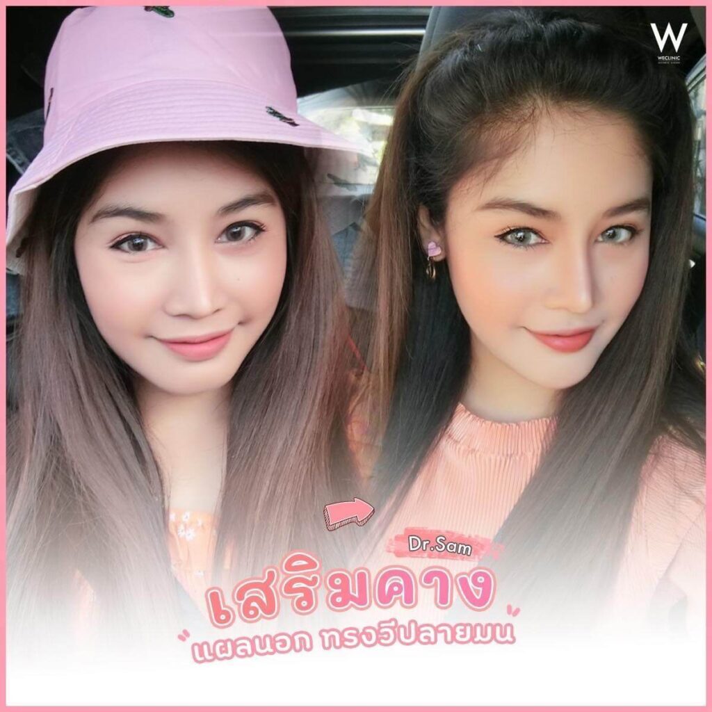 cover-เสริมคางแผลนอก-ทรงวี-ปลายมน-คืออะไร-ดีไหม-1024x1024