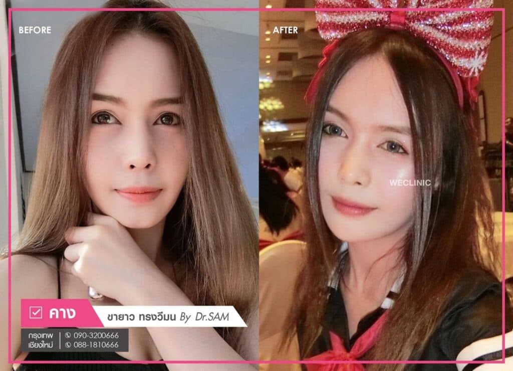 รีวิวซิลิโคนขายาว