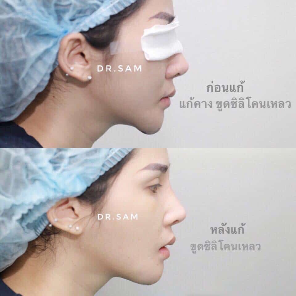 ก่อน-หลัง แก้คางเป็นก้อน-ไม่สวย